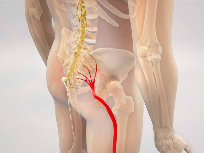 Do you suffer from Sciatica?