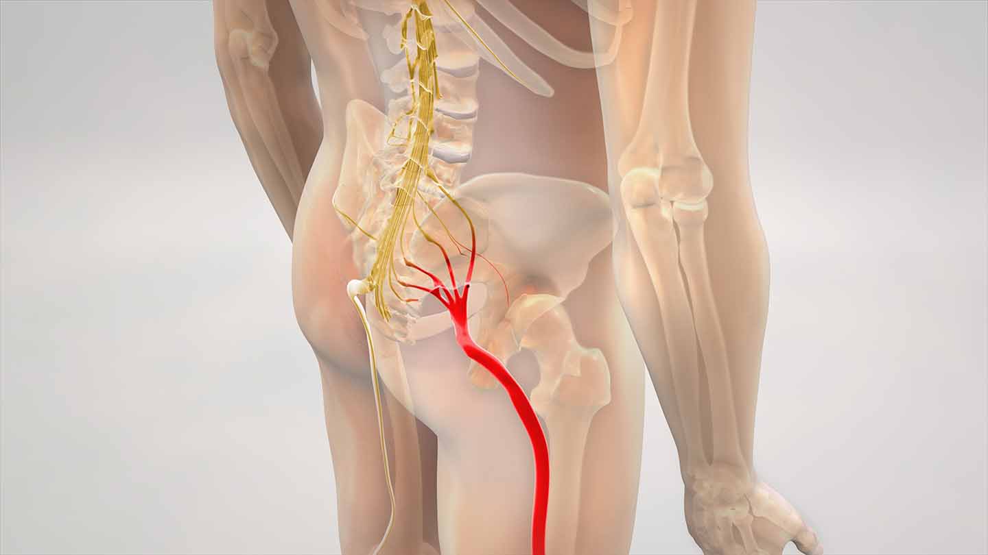 Do You Suffer From Sciatica?