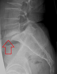 What Is Spondylolisthesis? Understanding the Basics